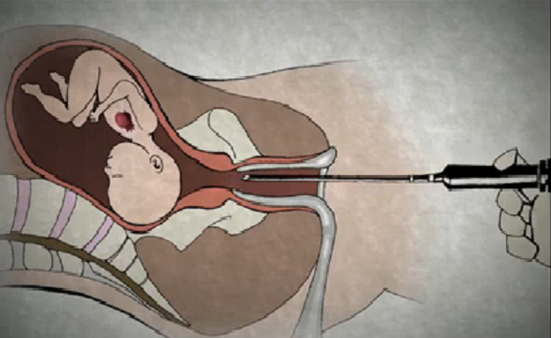 Shooting Babies Through the Heart With Poison to Kill Them