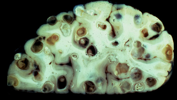 tapeworm
